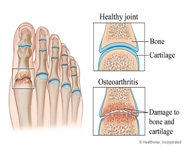 Arthritis-Coquitlam-Podiatry