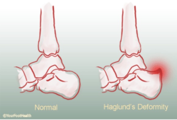 Haglunds-deformity-coquitlam-podiatry