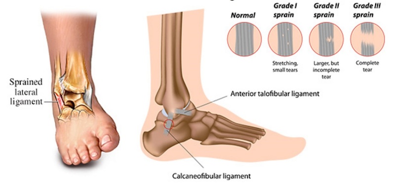 ankle-sprains-coquitlam-podiatry.