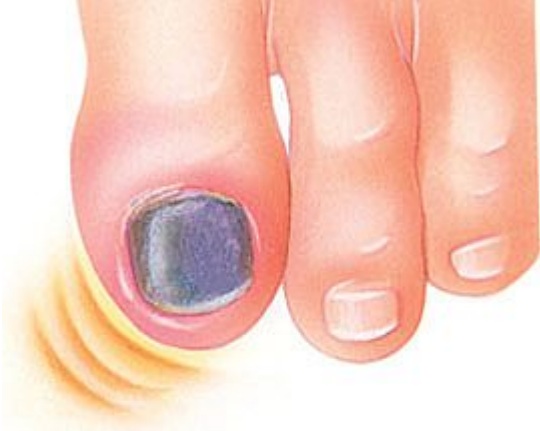 black-toenails-coquitlam-podiatry