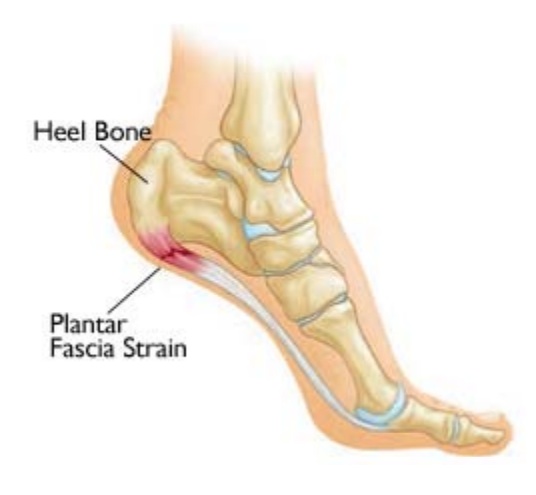 heel-pain-coquitlam-podiatry