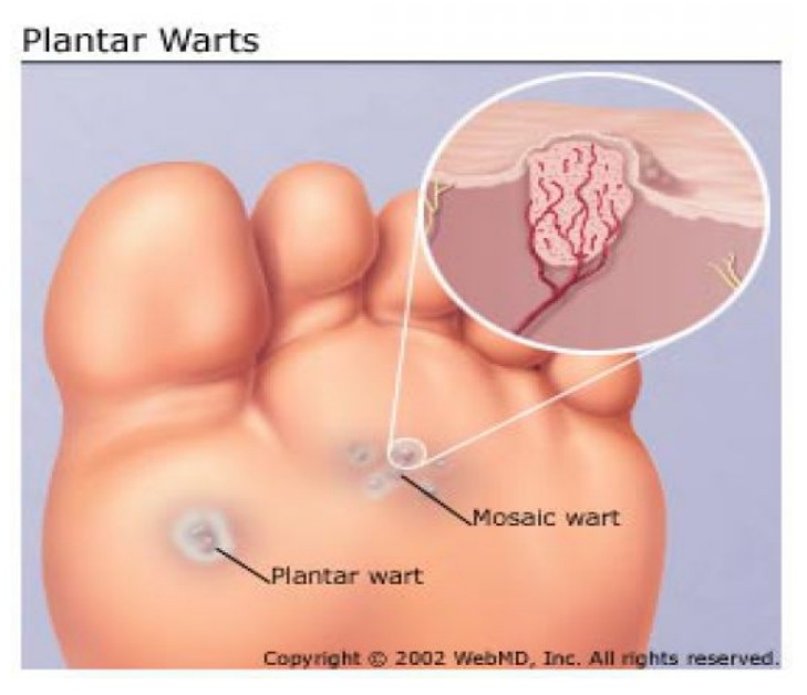 warts-coquitlam-podiatry