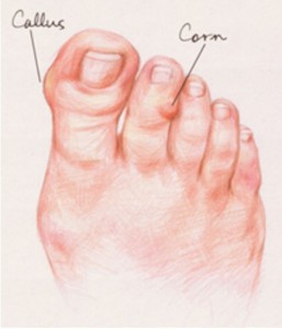 Corns and Calluses | Coquitlam Podiatry Foot and Ankle Clinic Coquitlam ...