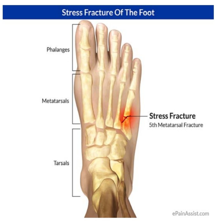 Stress Fracture | Coquitlam Podiatry Foot and Ankle Clinic Coquitlam ...